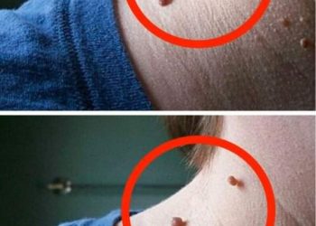 Wie kann man hängende Myome schnell und natürlich aus der Haut entfernen