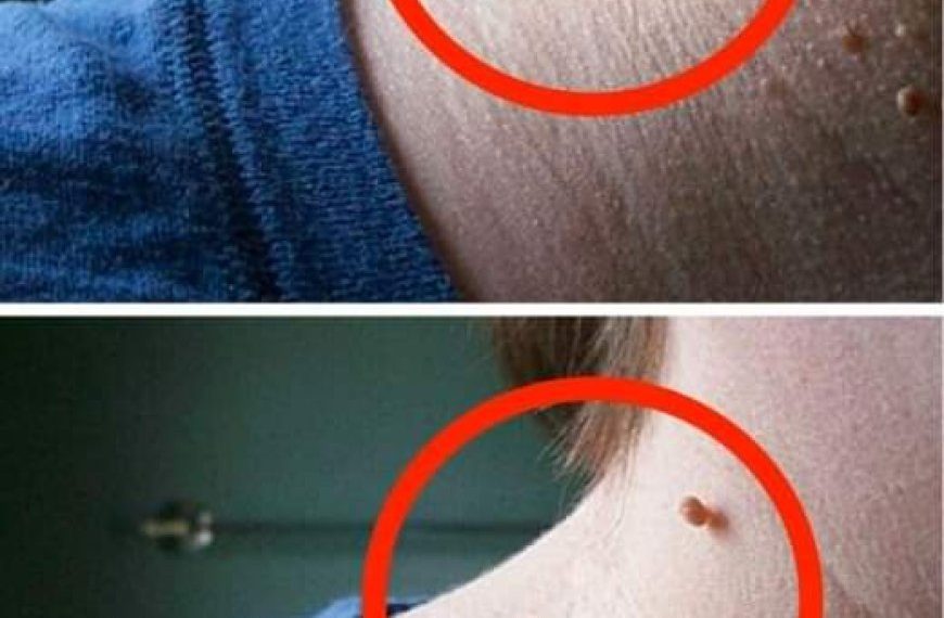 Wie kann man hängende Myome schnell und natürlich aus der Haut entfernen