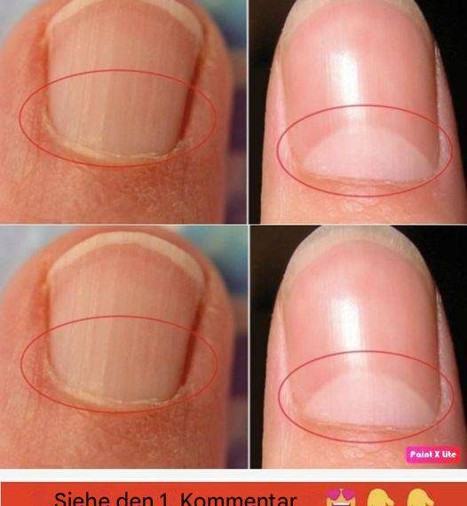 Wenn Ihre Nägel keine Halbmondform haben, suchen Sie sofort einen Arzt auf