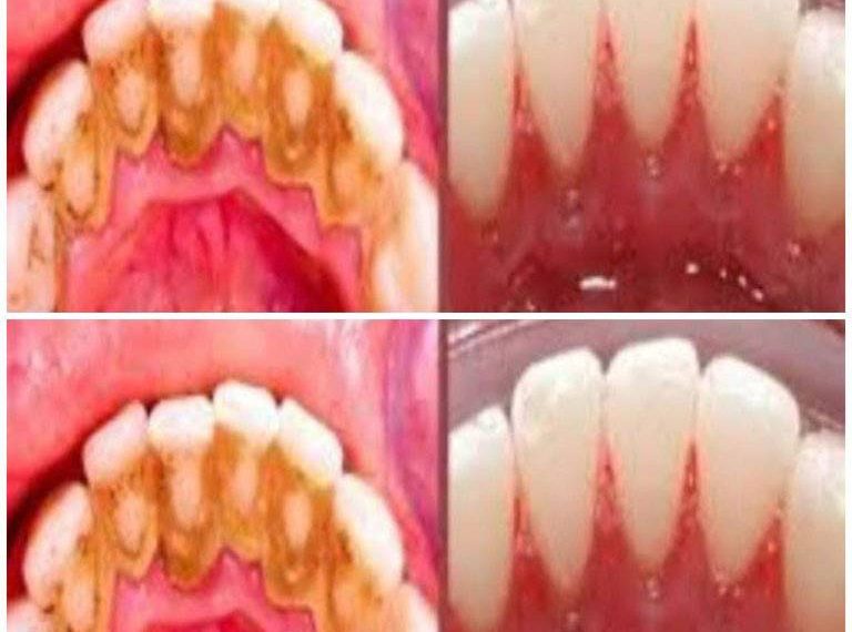 Zahnbelag selbst entfernen: Schnelles und einfaches Hausmittel