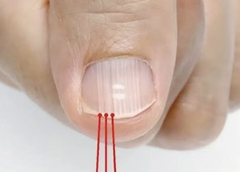 Was die vertikalen Linien auf Ihren Nägeln wirklich verraten