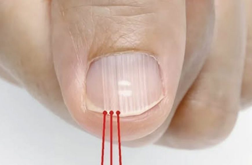 Was die vertikalen Linien auf Ihren Nägeln wirklich verraten