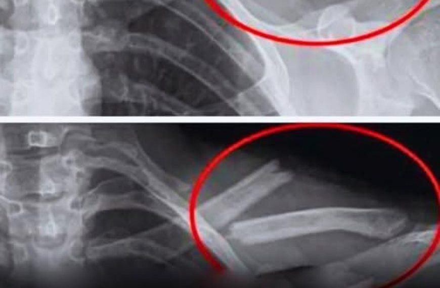 Dieses Getränk zerstört die Knochen, dennoch trinken viele Menschen es täglich