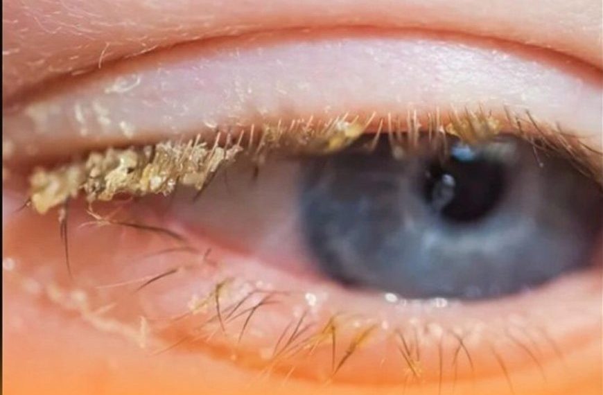 Gelbe Kruste beim Aufwachen: Was bedeutet das?