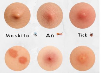 Identifizieren Sie die Stiche: So erkennen Sie häufige Insektenstiche