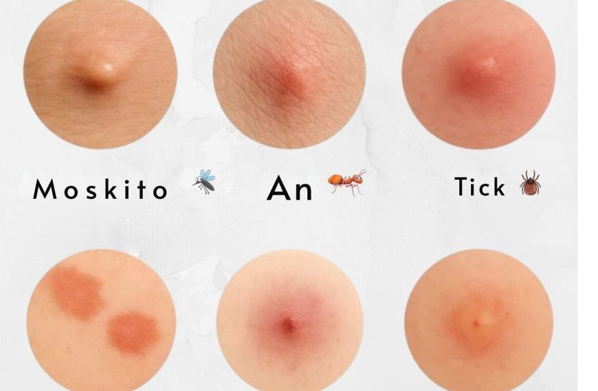 Identifizieren Sie die Stiche: So erkennen Sie häufige Insektenstiche