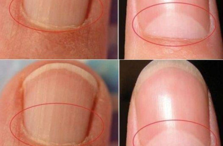 Wenn Ihre Nägel keine Halbmondform haben, suchen Sie sofort einen Arzt auf