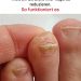 Der Trick zur Reduzierung der Zehennageldicke