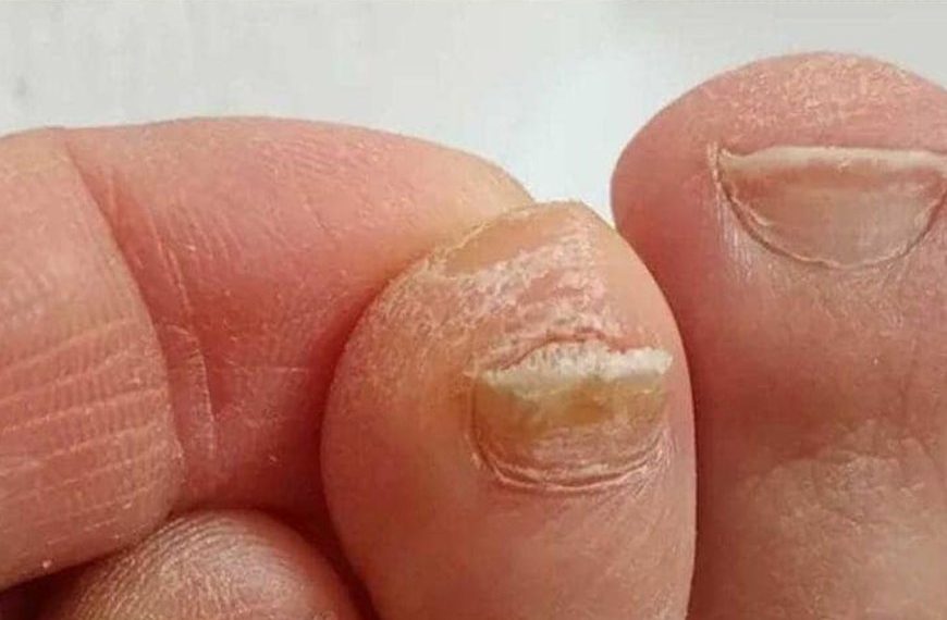 Der Trick zur Reduzierung der Zehennageldicke