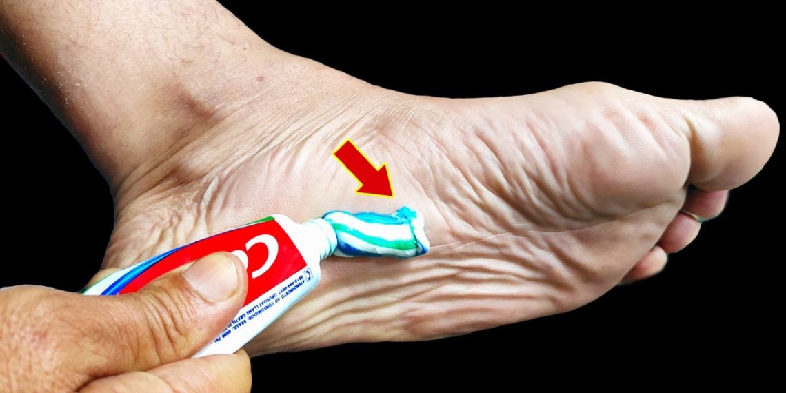 Du wirst überrascht sein, was passiert, wenn du Zahnpasta auf deine Füße aufträgst!