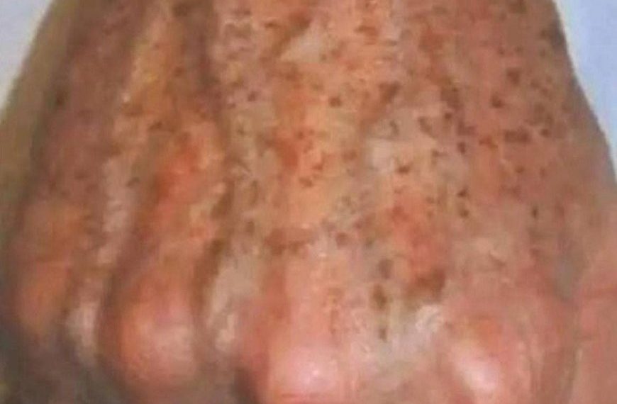 Warum bilden sich Flecken auf den Händen und wie kann man sie entfernen?