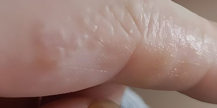 Das sind diese kleinen juckenden Beulen an deinen Fingern