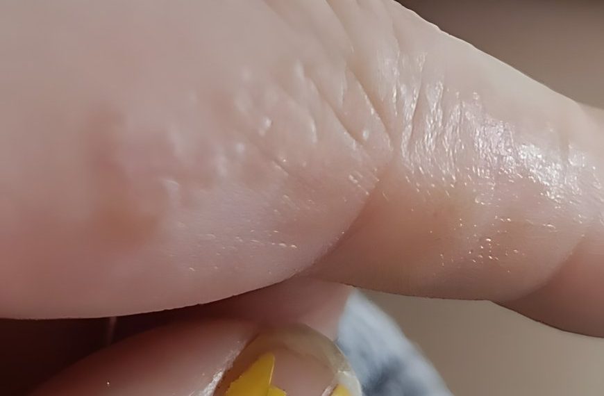 Das sind diese kleinen juckenden Beulen an deinen Fingern